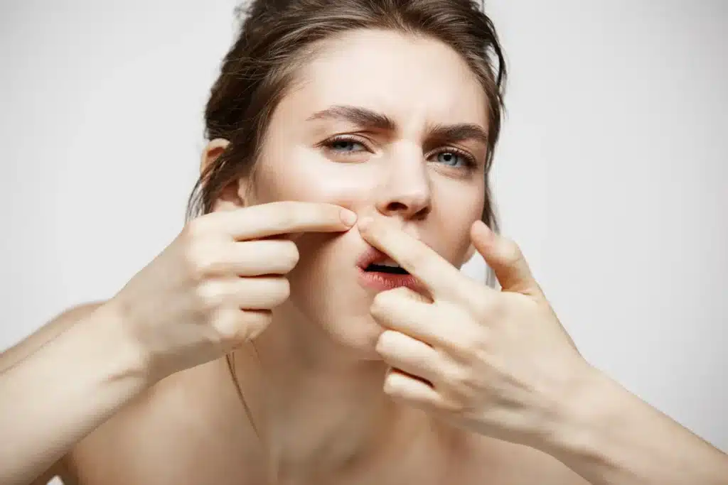 A girl with a visible pimple, highlighting monsoon skin concerns in Varsha Ritucharya.